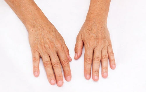 age-spots on hands